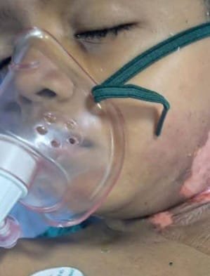 भिलाई के कैंप में झुलसे दिव्यांश की सर्जरी के लिए विधायक रिकेश की एक और पहल*