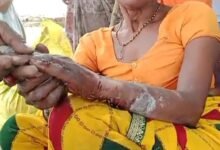 नगरिया-हसनपुर रोड के गड्ढों में पलटा ई-रिक्शा, महिला का हाथ टूटा